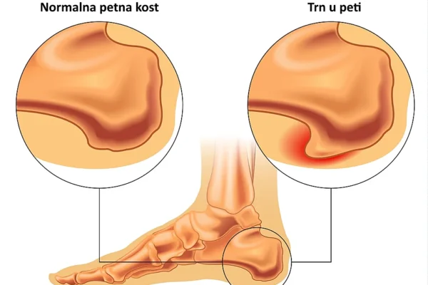 trn u peti